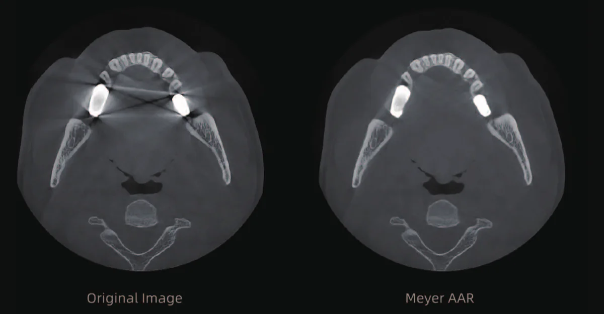 Comparación de imagen CBCT original y con reducción de artefactos metálicos Meyer AAR