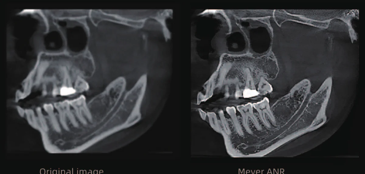 Comparación de imagen CBCT original y con reducción de ruido Meyer ANR
