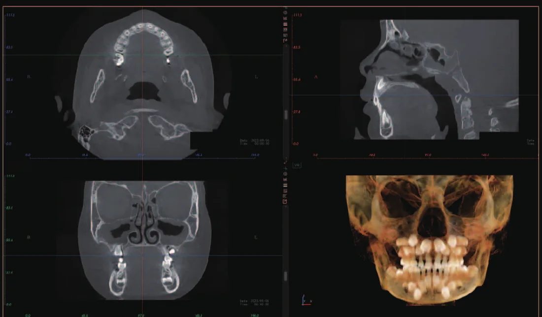 CBCT de dentición mixta en niños