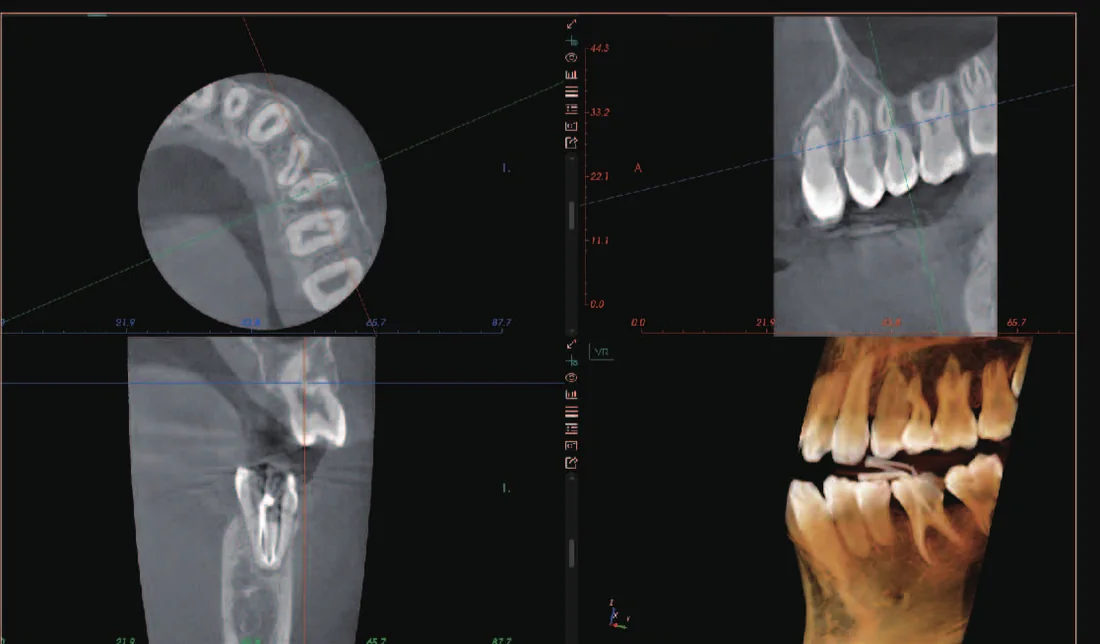 CBCT de ectopia dental