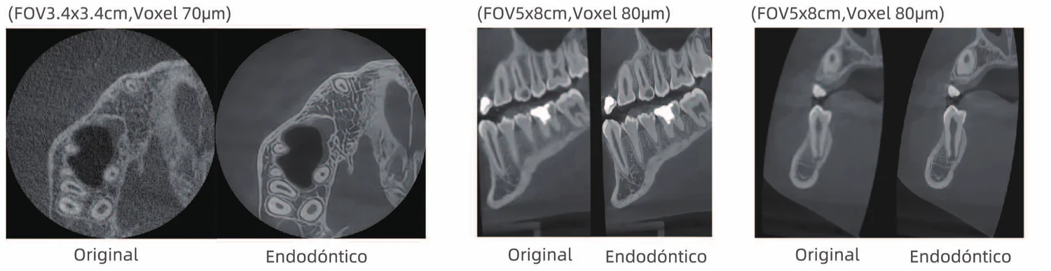 Comparación de imágenes originales y endodónticas en CBCT
