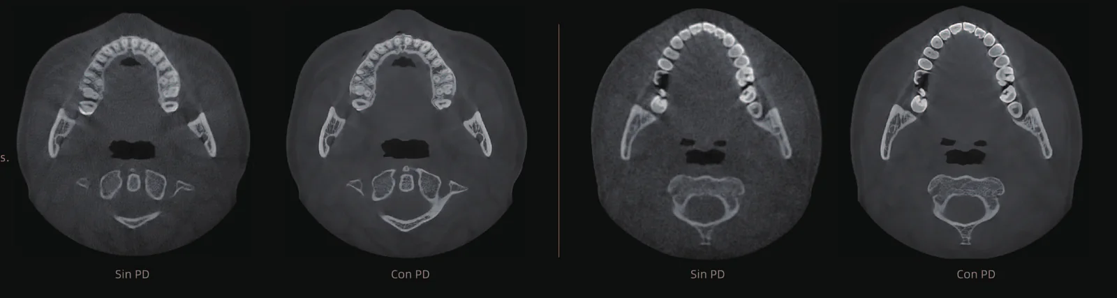 Cortes axiales CBCT sin y con tecnología Pure Detail