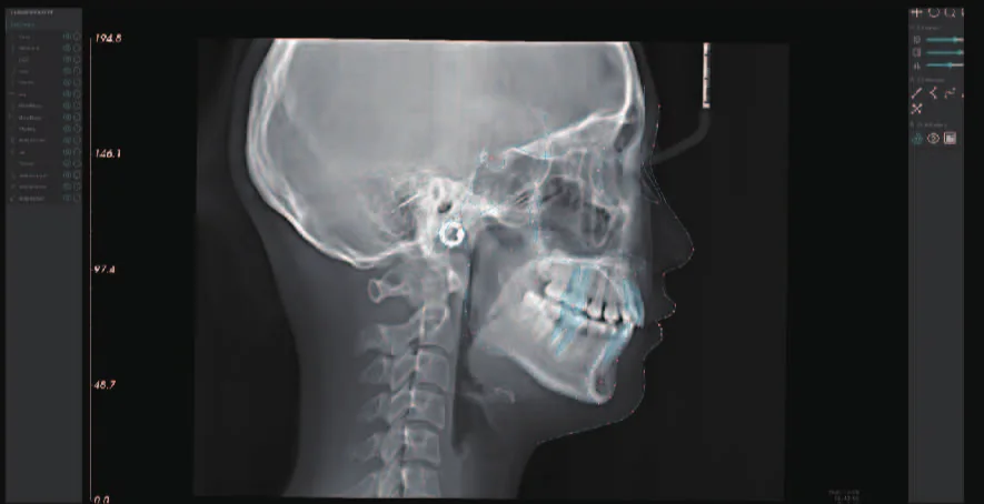 Análisis cefalométrico automático en MyDentViewer