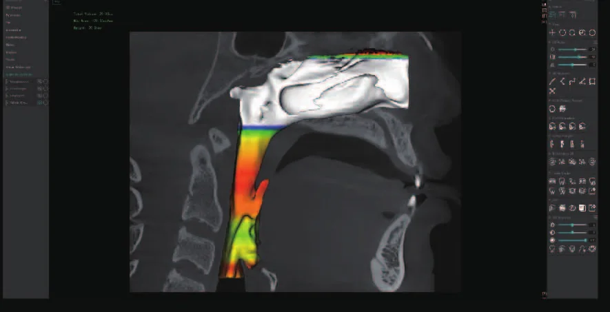 Análisis de vía aérea con IA en MyDentViewer