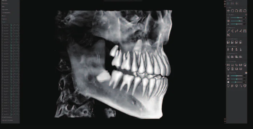 Segmentación de dientes con IA en MyDentViewer