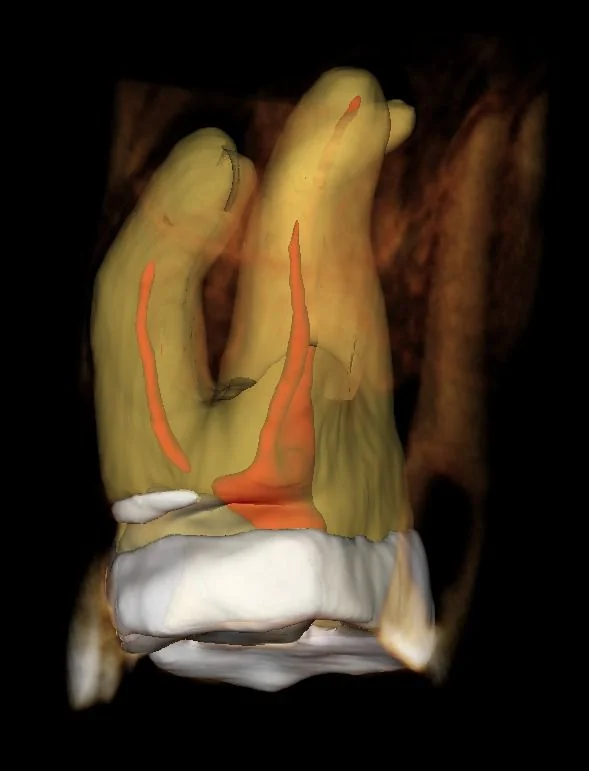 Premolar superior en 3D con conductos radiculares resaltados
