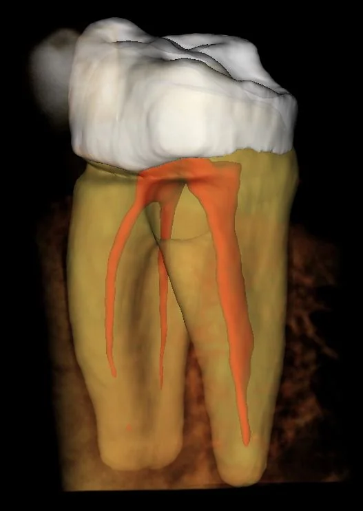 Molar en 3D con conductos radiculares marcados por IA