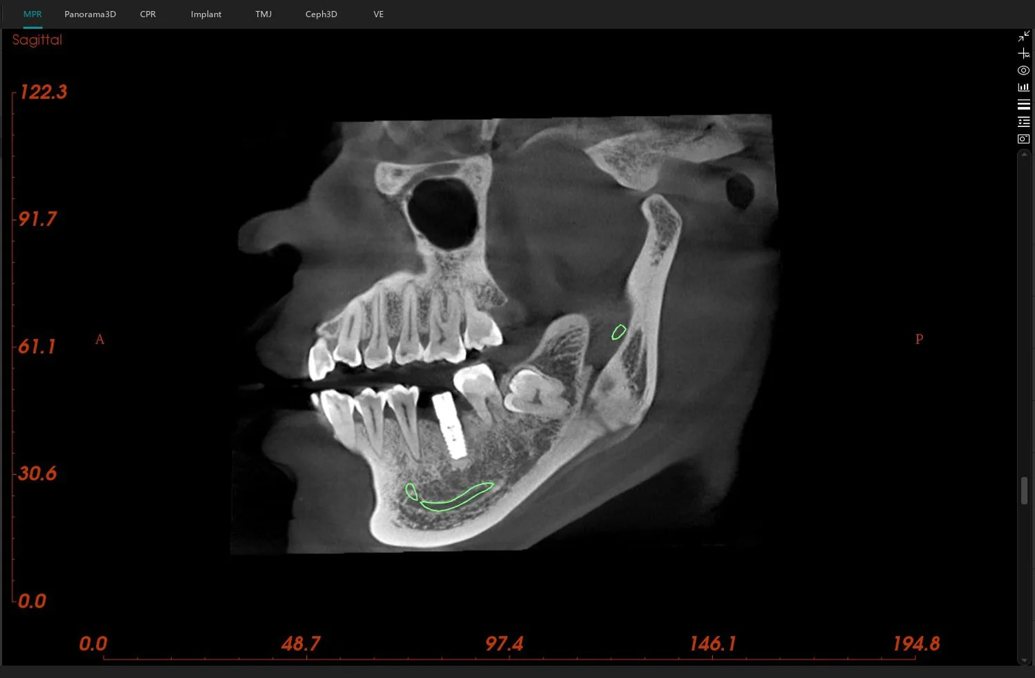 Corte sagital con canal del nervio dentario marcado automáticamente